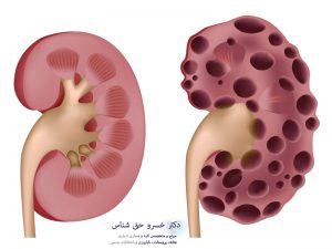 کیست کلیه