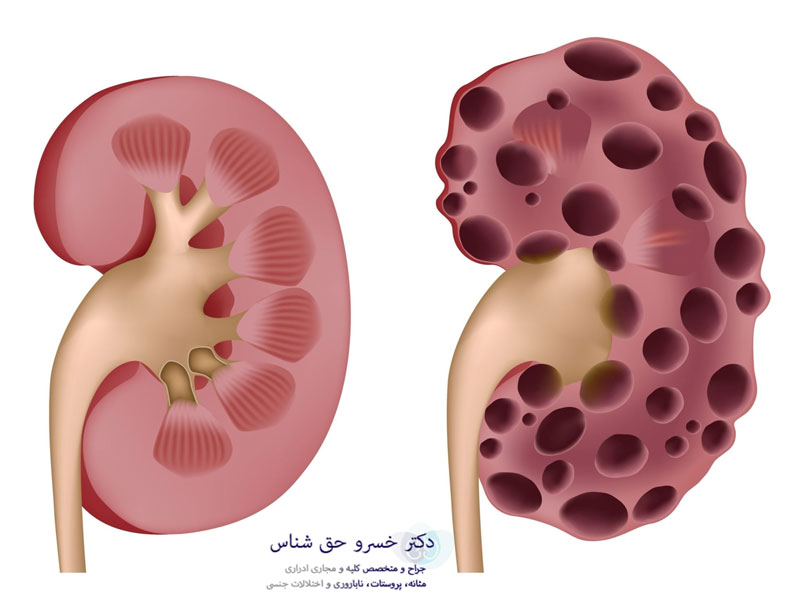 کیست کلیه