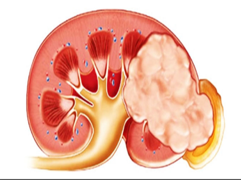 تصویر تومور کلیه