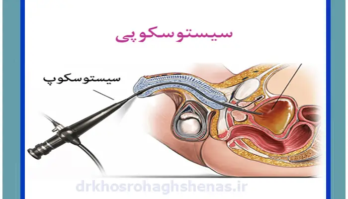 سیستوسکوپ چیست