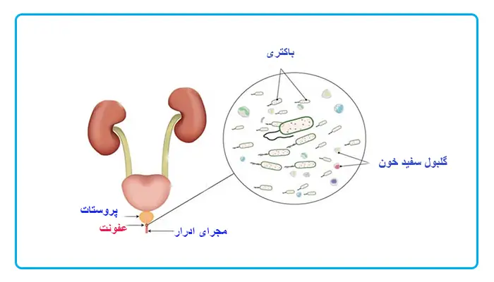 التهاب مجاری ادراری