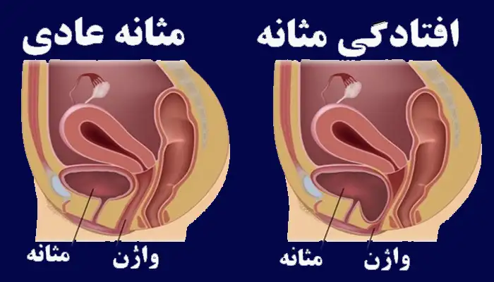 سیستوسل