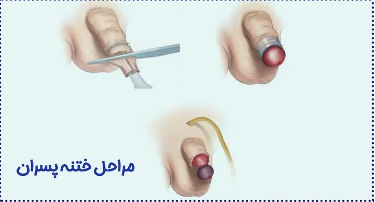 مراحل ختنه