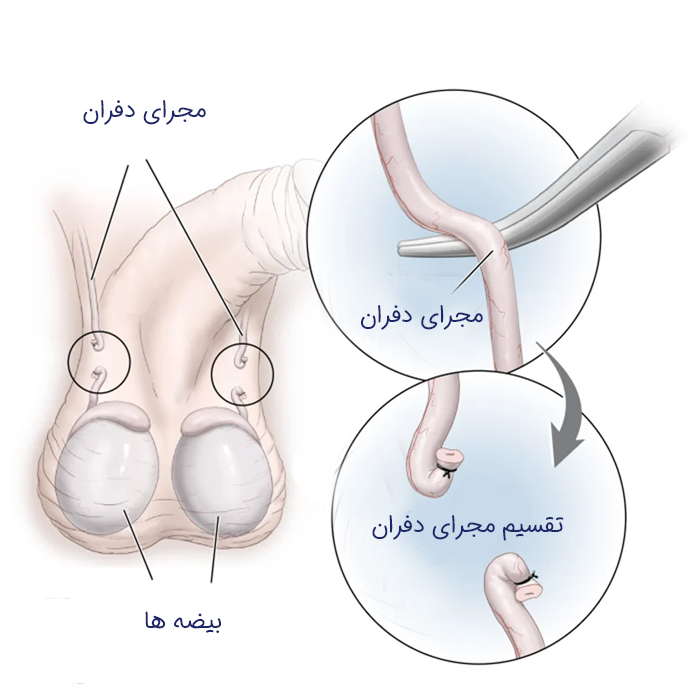 نحوه انجام وازکتومی