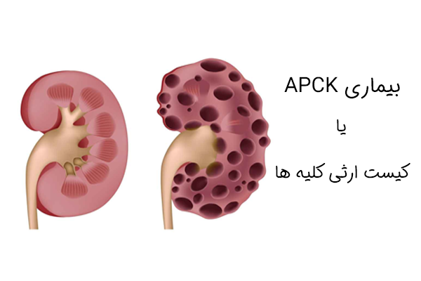 بیماری APCK